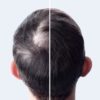 Before and after of hair loss treatment