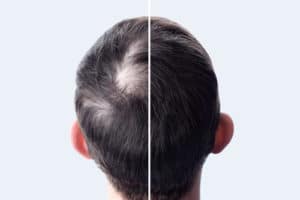 Before and after of hair loss treatment
