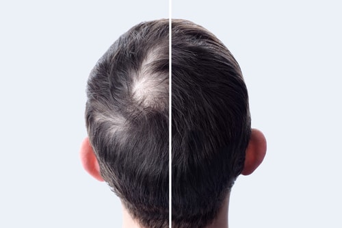 Men,Hair,After,Using,Cosmetic,Powder,For,Hair,Thickening.,Crown