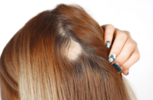 Caucasian woman with spot alopecia, bald spot on her head