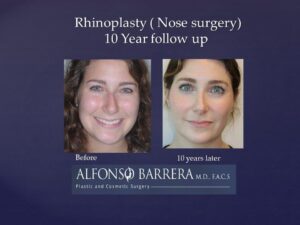 young woman before and 10 years after rhinoplasty, nose straighter after procedure