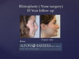 side profile of young woman before and 10 years after rhinoplasty