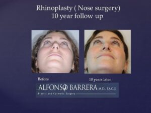 underside view young woman's nose before and 10 years after rhinoplasty, deviated septum corrected after procedure