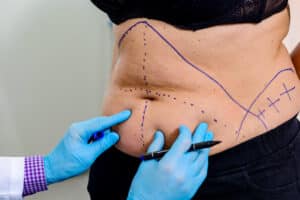 Doctor marking woman’s stomach for tummy tuck and mommy makeover