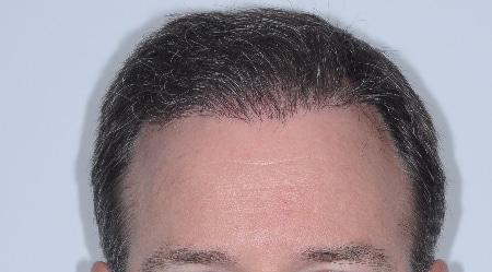 after hair restoration houston texas