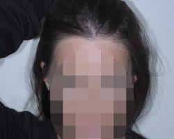 after Female Hair Transplant Houston TX