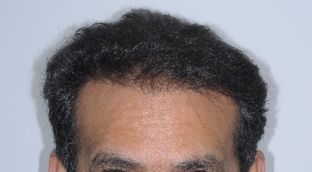 after hair transplant houston texas