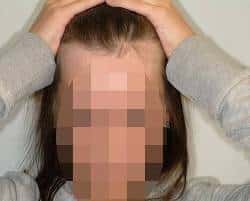 before Female Hair Transplant Houston TX