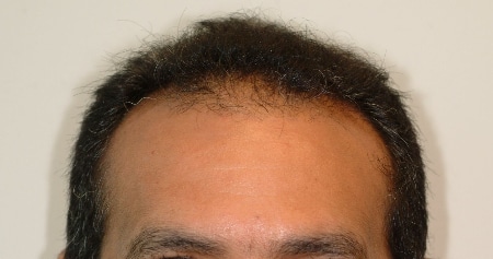 before hair transplant houston texas
