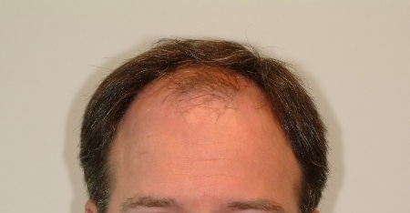 before hair restoration houston texas