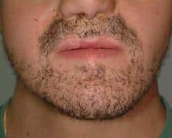 after beard and mustache hair transplantation Houston TX