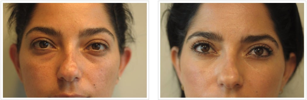 Eyelid Surgery