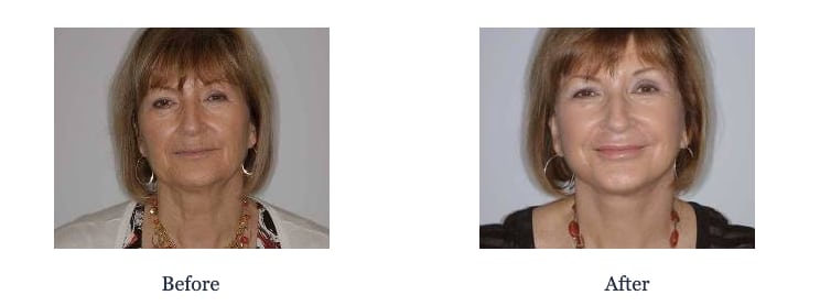 Facelift