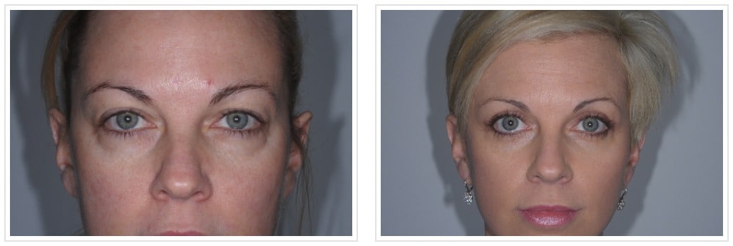 FireShot Capture 313 Blepharoplasty Archives Alfonso Bar https www.lookinggood.com before