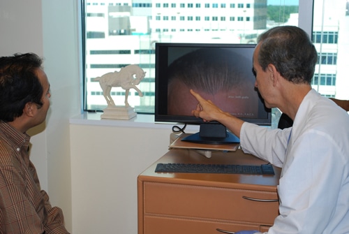 dr b show after result hair transplant
