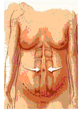 houston abdominoplasty 3