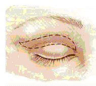 houston blepharoplasty 3