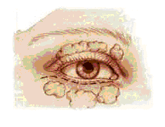 houston blepharoplasty 4