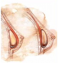 houston breast augmentation illustration