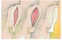 houston otoplasty 2
