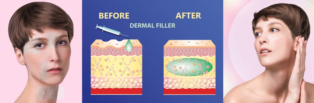 Cosmetic filler or dermal fillers