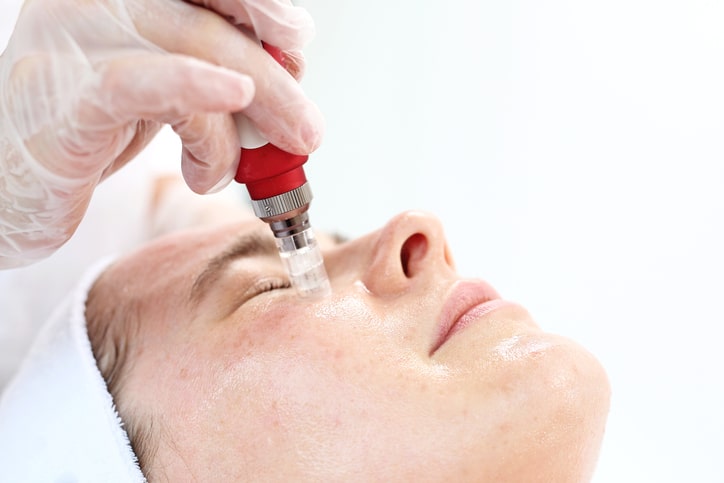 Microneedle mesotherapy, treatment woman at the beautician