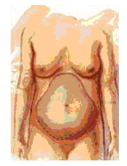 houston abdominoplasty 2