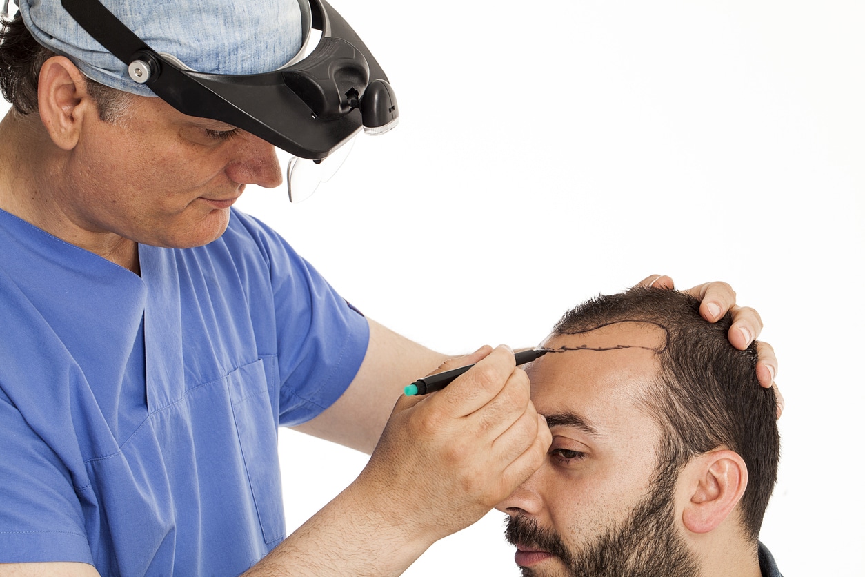Hair Transplant Houston TX