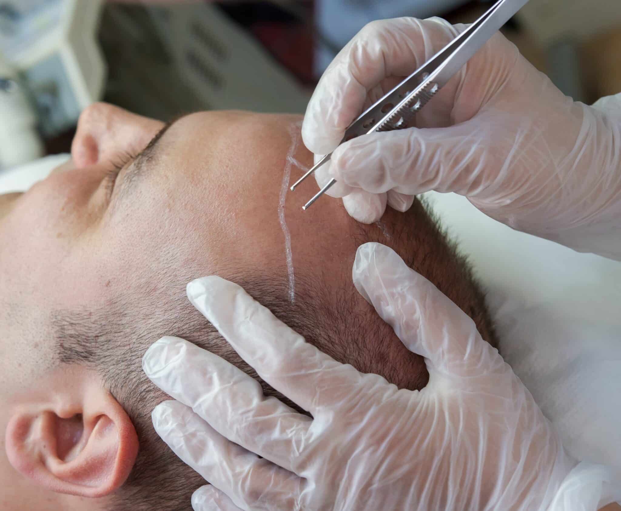 hair transplant procedure houston TX