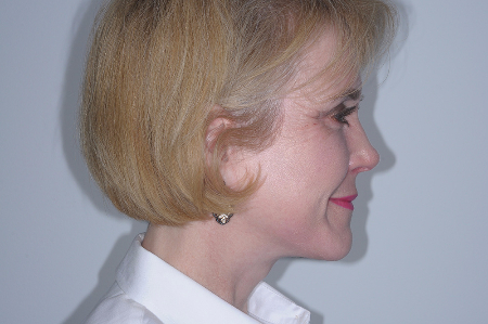 After Image: Patient # 59150 - right-side