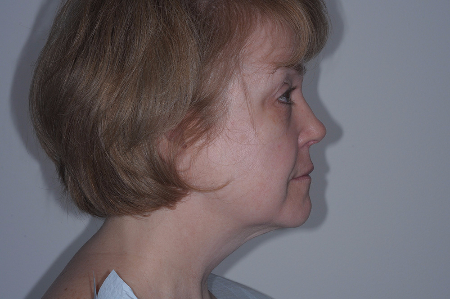 Before Image: Patient # 59150 - right-side
