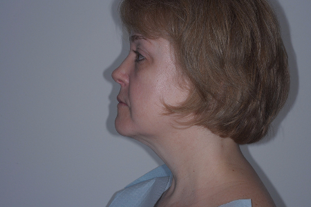 Before Image: Patient # 59150 - left-side
