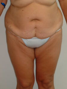 Before Image: Patient # 22169