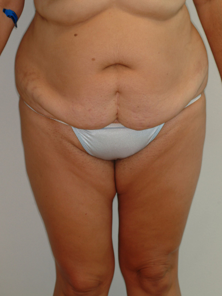 Before Image: Patient # 22169 - front