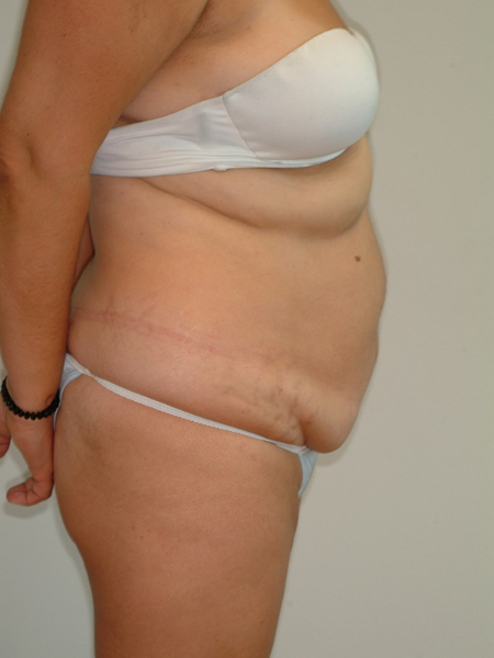 Before Image: Patient # 22169 - right-side
