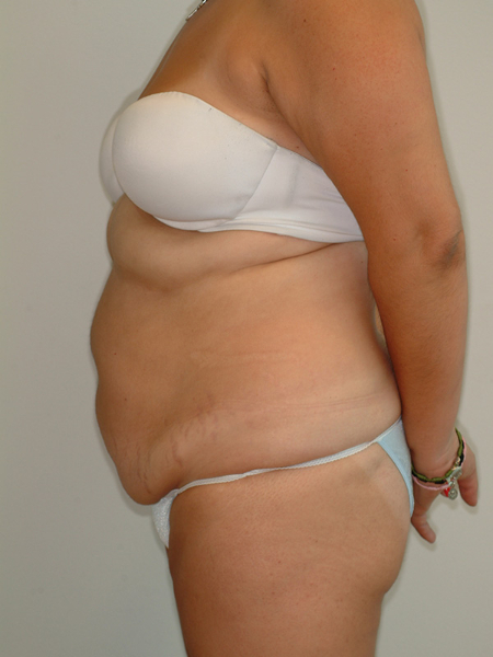 Before Image: Patient # 22169 - left-side