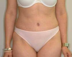 After Image: Patient # 30249 - front
