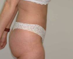 After Image: Patient # 30249 - right-side