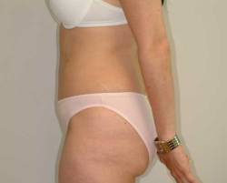 After Image: Patient # 30249 - left-side