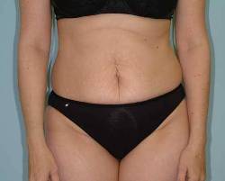 Before Image: Patient # 30249 - front