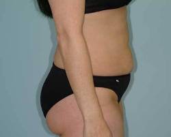 Before Image: Patient # 30249 - right-side