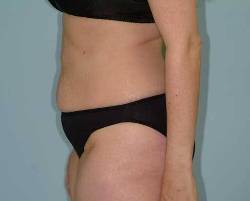 Before Image: Patient # 30249 - left-side