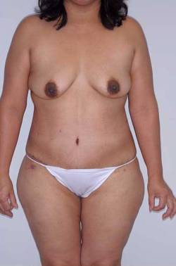 After Image: Patient # 45746 - front