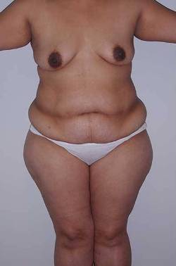 Before Image: Patient # 45746 - front