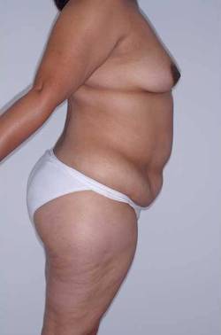 Before Image: Patient # 45746 - right-side