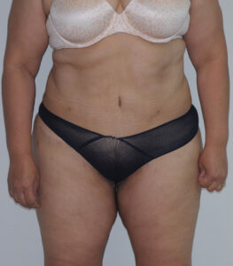 After Image: Patient # 60525