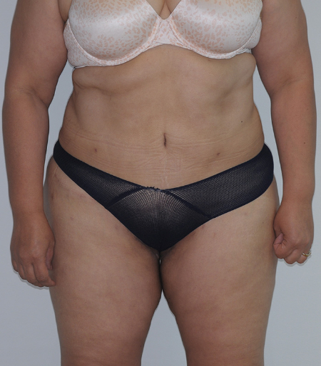 After Image: Patient # 60525 - front