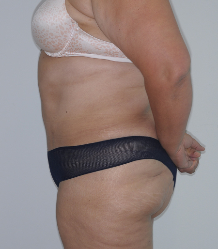 After Image: Patient # 60525 - left-side