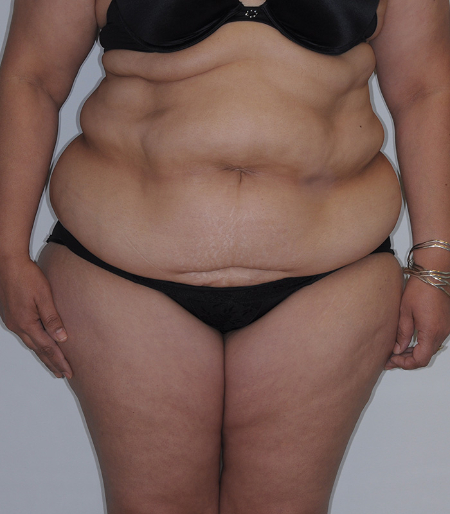 Before Image: Patient # 60525 - front