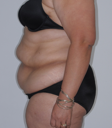 Before Image: Patient # 60525 - left-side